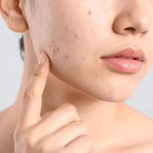 Best acne treatments