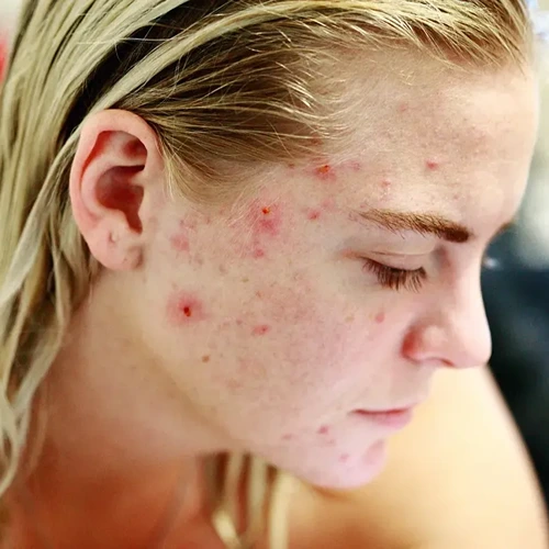 Skin disease Ayurvedic treatment